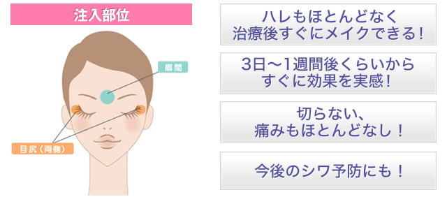 切らない、痛みもほとんどなし！今後のシワ予防にも！ハレもほとんどなく治療後すぐにメイクできる！3日～1週間後くらいからすぐに効果を実感！